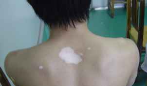 白癜风治疗